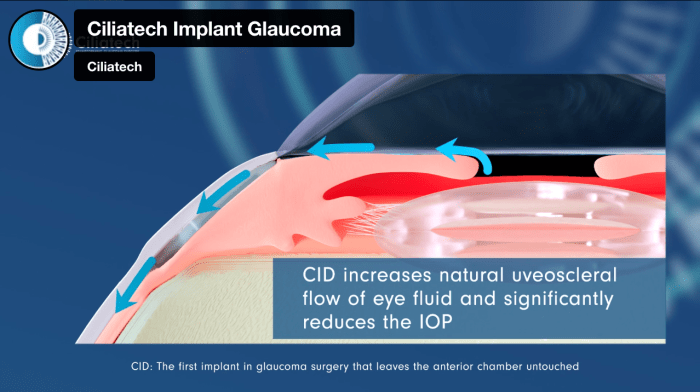 Drainage glaucoma implant surgery ahmed implants procedure